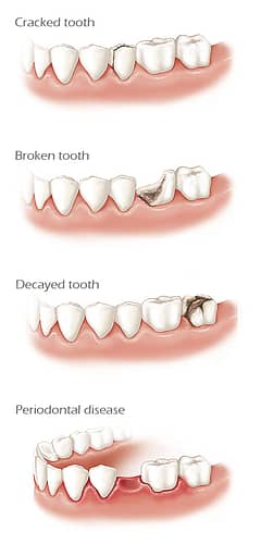 Reasons for Tooth Loss