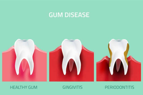 Difference between Periodontitis And Gingivitis