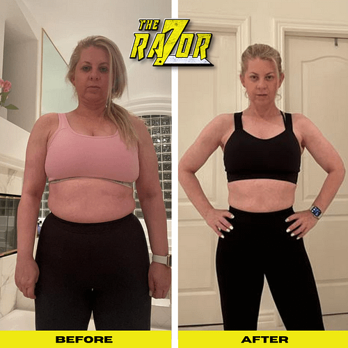 Lipedema before And After Weight Loss