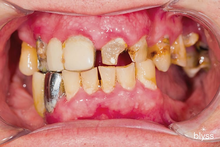 Teeth Diseases