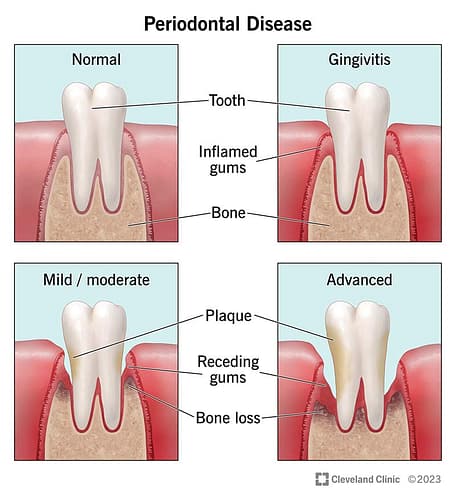 Diseases That Affect the Gums around the Teeth