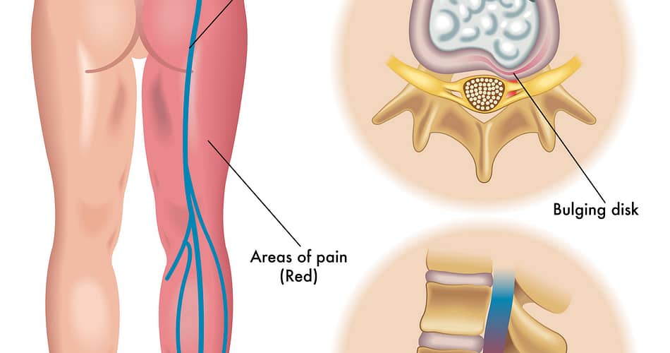 Back of the Knee Vein And Pain Natural Remedies