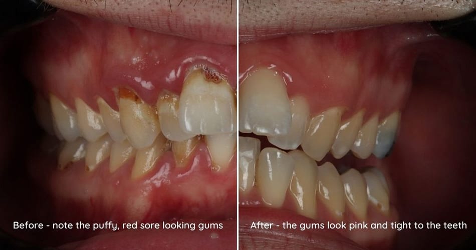 Gum Disease Look Like