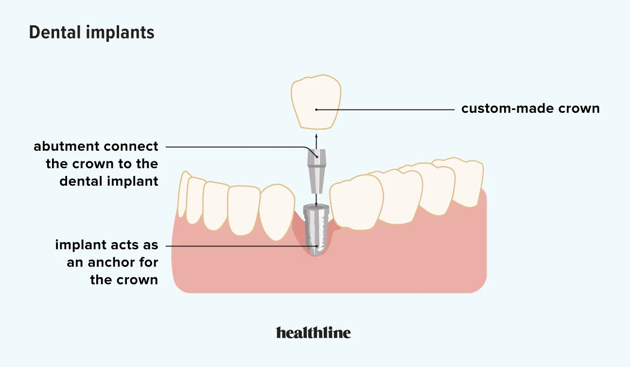 Transform Your Body: Weight Loss After Dental Implant Surgery 2024!